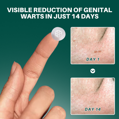 ODALIT™ Magnesium MicroPin HPV Genital Wart Removal Patch | Pain-Free, Clinically Proven Solution