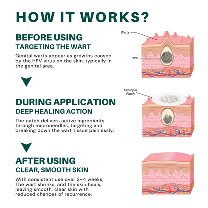ODALIT™ Magnesium MicroPin HPV Genital Wart Removal Patch | Pain-Free, Clinically Proven Solution